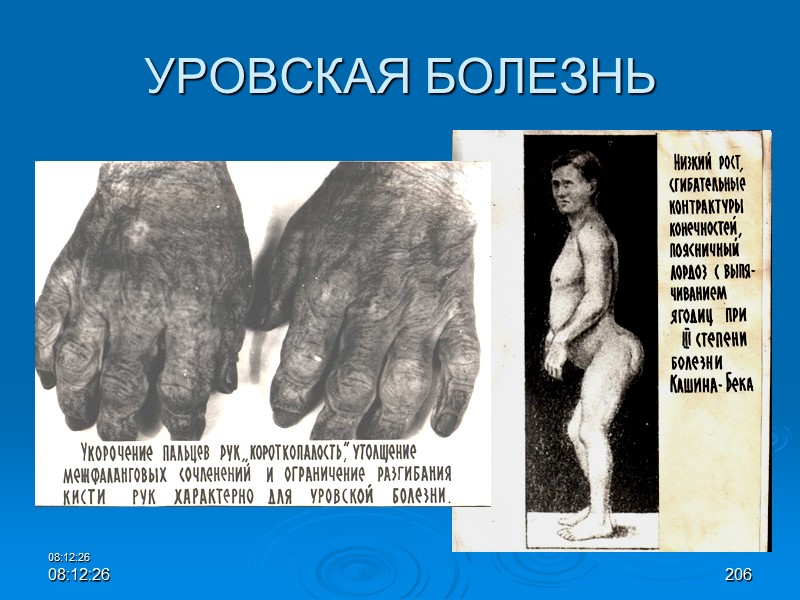 08:12:02 08:12:02 206 УРОВСКАЯ БОЛЕЗНЬ